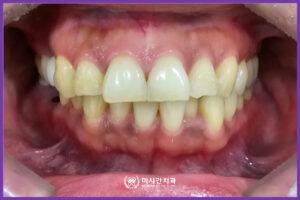 치료전1교합