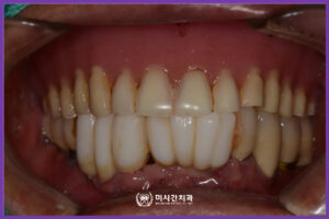 4치료전 앞면