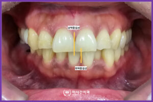 상악중심선2
