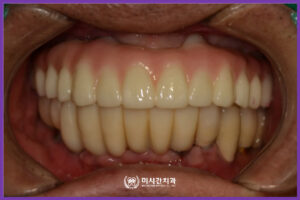 7 치료후