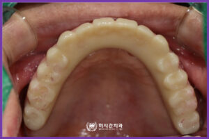 8 풀아치임플란트