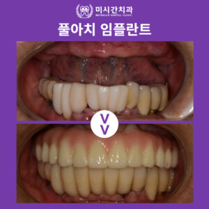 9 치료전후사진