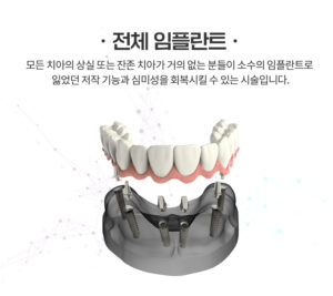 전체임플란트