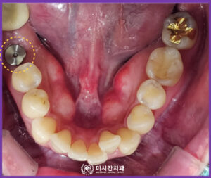 교합면4