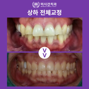 상하 전체교정