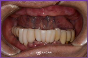 연산역임플란트잘하는곳 2 치료전