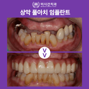 연산동치과 풀아치임플란트