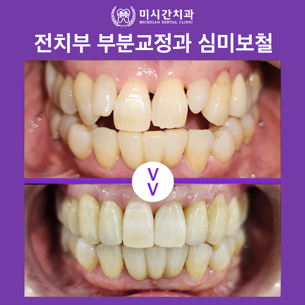 ㅊㅇ
