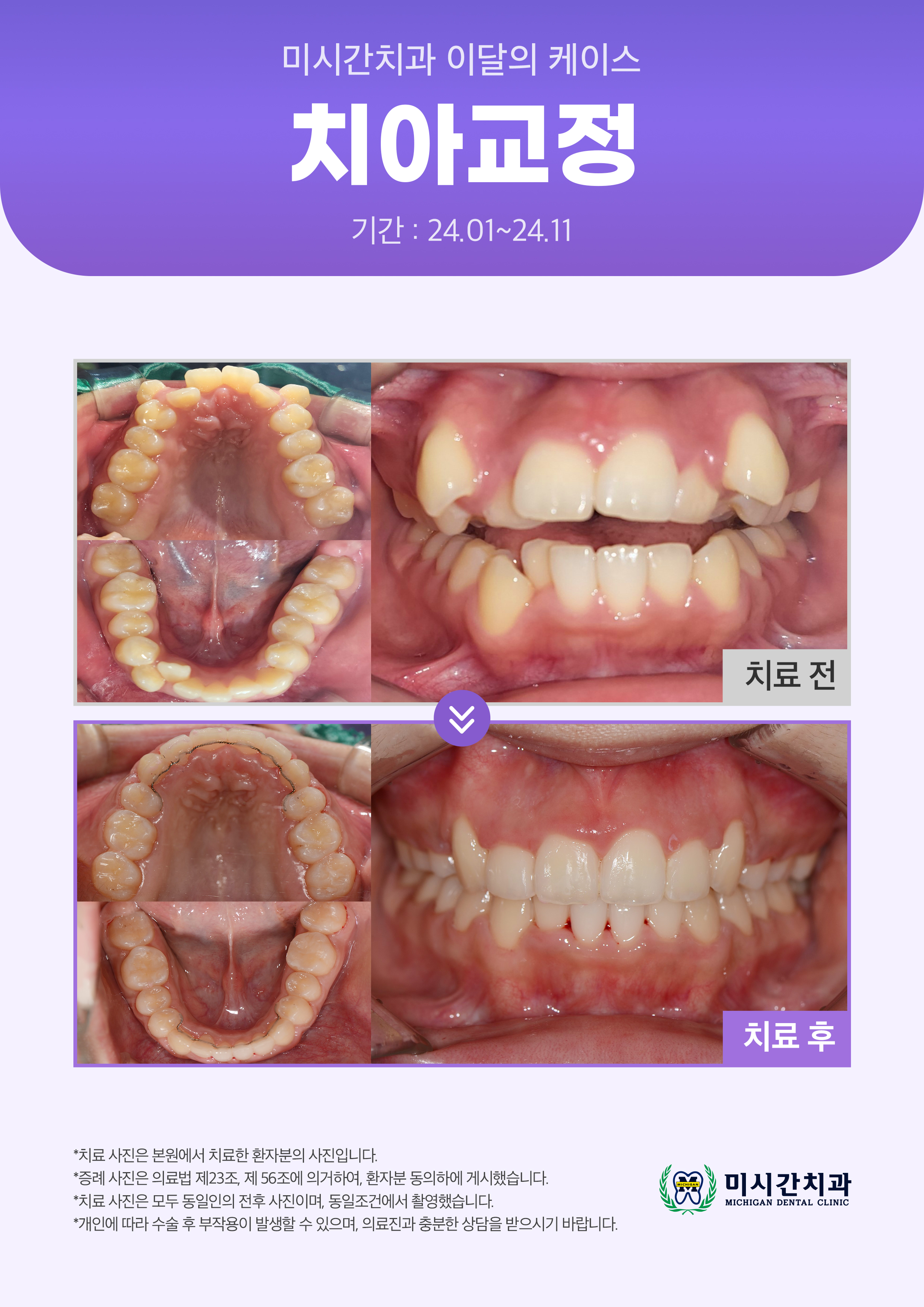 ●25.03.19 미시간치과_이달의 케이스1
