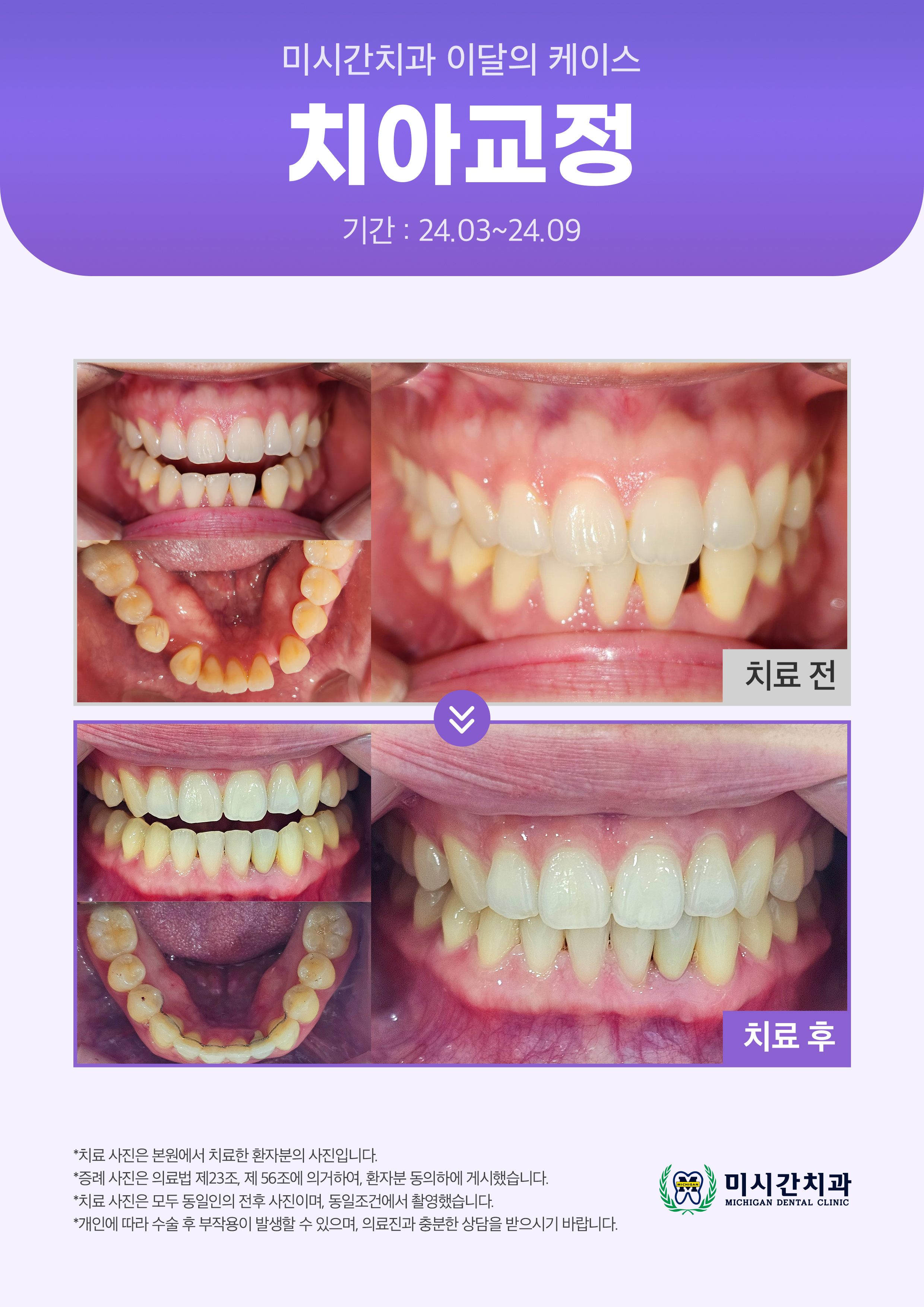 ●25.03.19 미시간치과_이달의 케이스2