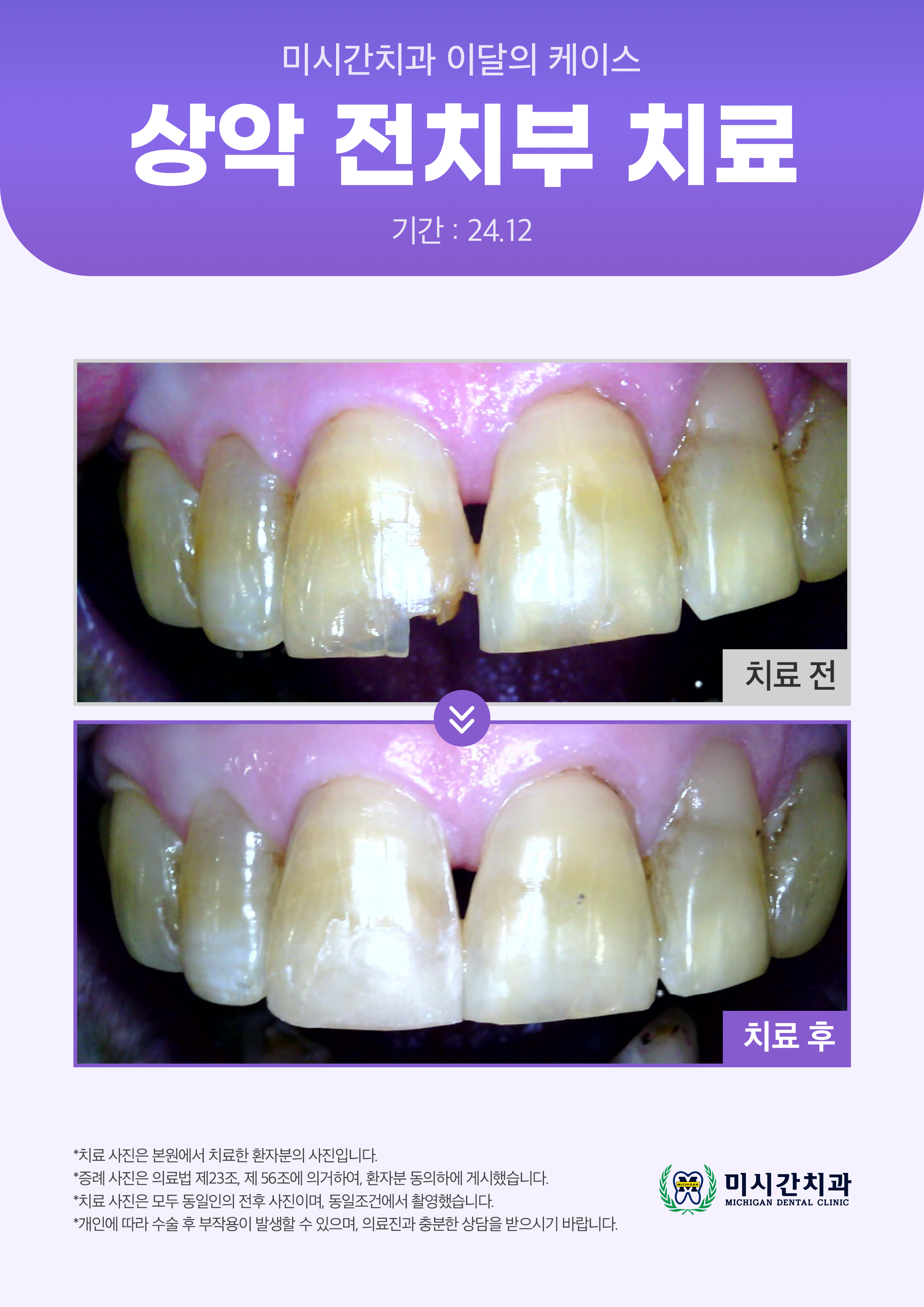 25.03.19 미시간치과_이달의 케이스7