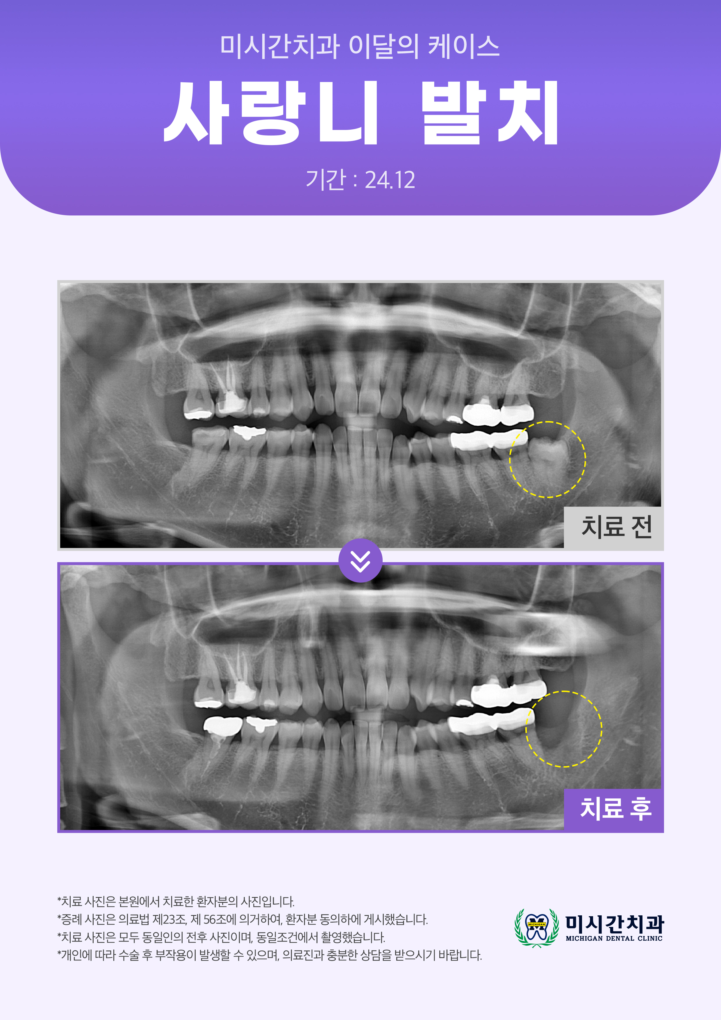 25.03.19 미시간치과_이달의 케이스4