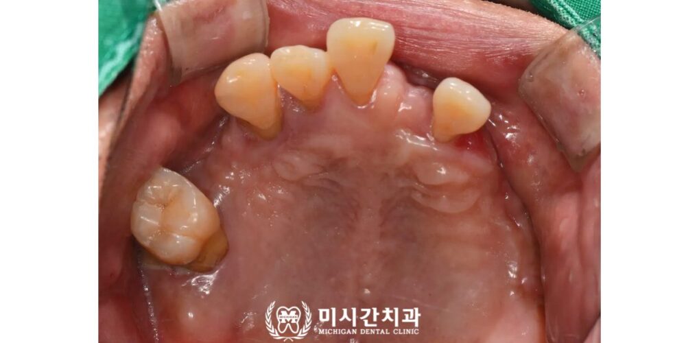 연산동풀아치임플란트