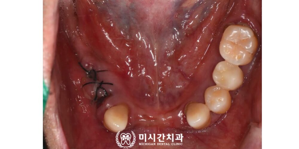 연산동풀아치임플란트