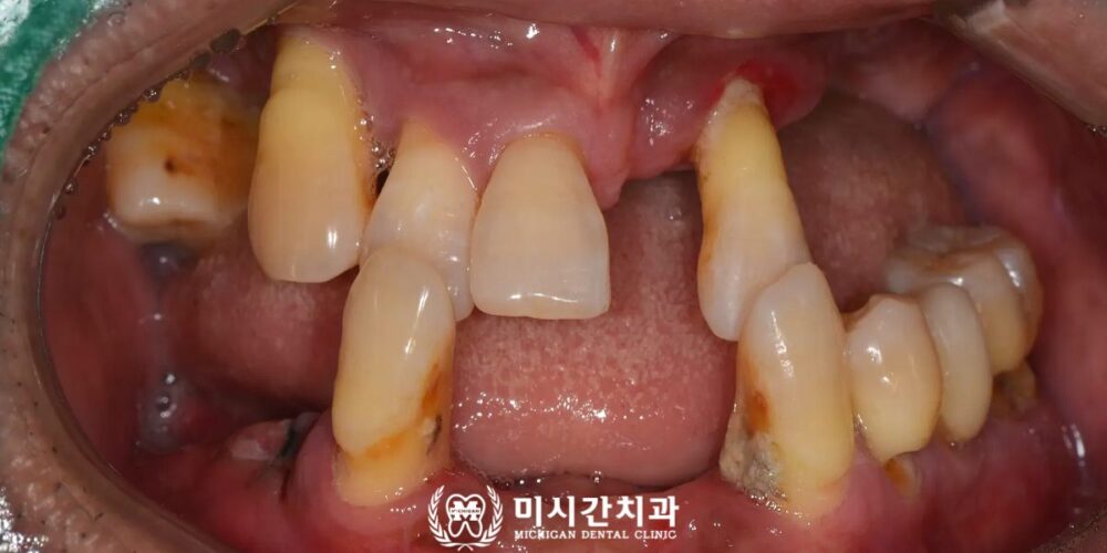 연산동풀아치임플란트