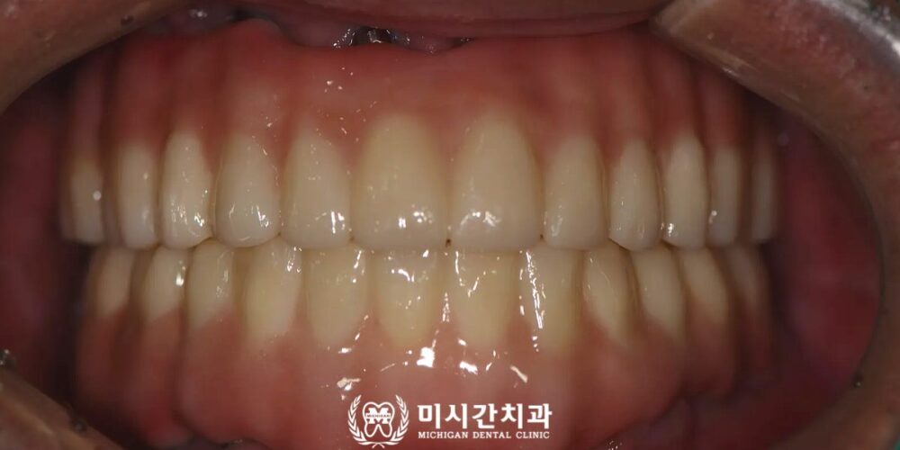 연산동풀아치임플란트