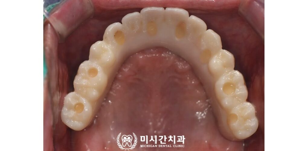 연산동풀아치임플란트