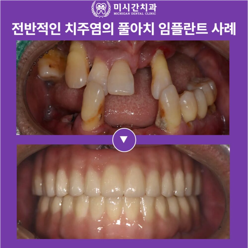 연산동풀아치임플란트