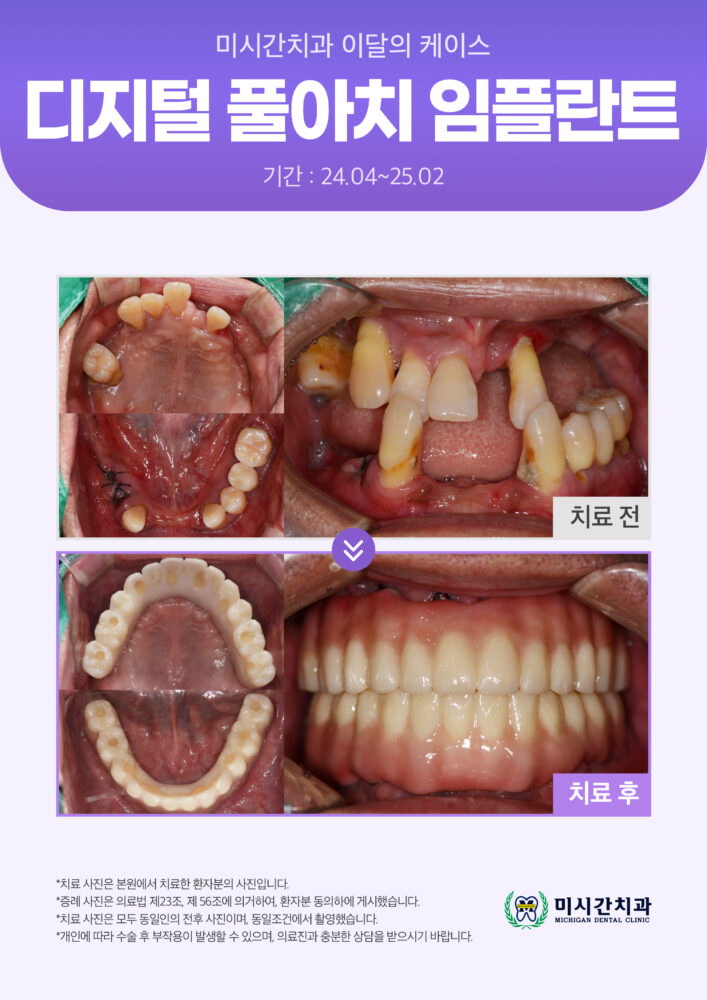 ●25.03.19 미시간치과_이달의 케이스8